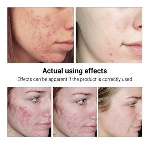 BREYLEE Acne Treatment Serum Face Facial Anti Acne Scar Removal Cream Skin Care Whitening Repair Pimple Remover For Acne - Zambeel