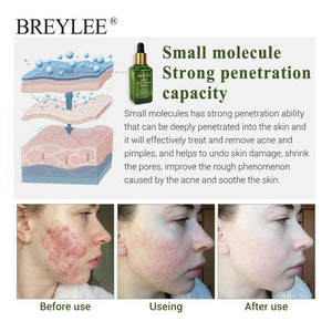 BREYLEE Acne Treatment Serum Face Facial Anti Acne Scar Removal Cream Skin Care Whitening Repair Pimple Remover For Acne - Zambeel