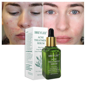 BREYLEE Acne Treatment Serum Face Facial Anti Acne Scar Removal Cream Skin Care Whitening Repair Pimple Remover For Acne - Zambeel