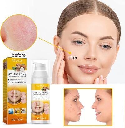 Eelhoe - Cystic Acne Cream (Original) - Zambeel