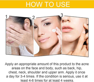 Eelhoe - Cystic Acne Cream (Original) - Zambeel