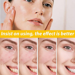 Eelhoe - Cystic Acne Cream (Original) - Zambeel