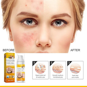 Eelhoe - Cystic Acne Cream (Original) - Zambeel