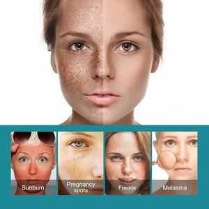 Eelhoe - Dark Spots Removes Cream (Original) - Zambeel