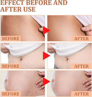Eelhoe - Stretch Marks Removal Cream (Original) - Zambeel