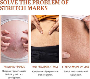 Eelhoe - Stretch Marks Removal Cream (Original) - Zambeel
