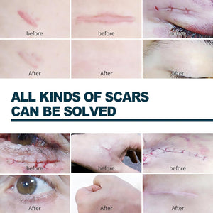 Elehoe - Advanced Scar Gel - Zambeel