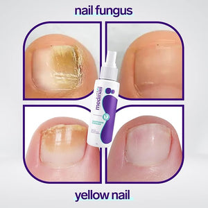 Jaysuin - Nail Fungus Spray (Original) - Zambeel