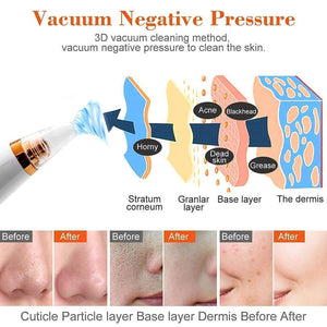 Multi - Functional Blackhead Remover - Zambeel