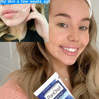 PanOxyl - Acne Creamy Wash (Original) - Zambeel