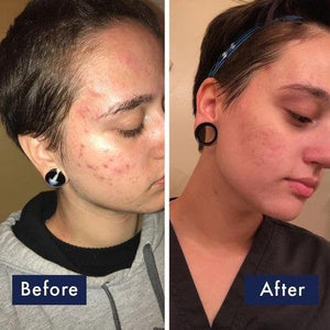 PanOxyl - Acne Foaming Wash (Original) - Zambeel