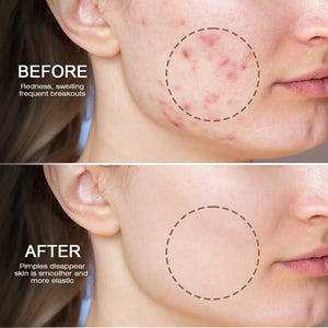 Snmifun - Bee Anti - Acne Gel - Zambeel