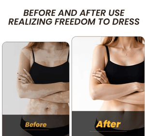 Sumifun - Vitamine Vitiligo Cream (Original) - Zambeel