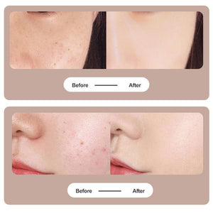 Tattoo Mole Removal Plasma Pen Laser Facial Freckle Dark Spot Remover Tool Wart Removal Machine Face Skin Care Beauty Device - Zambeel